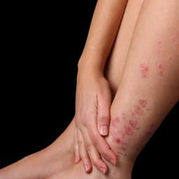 Psoriasis-Patienten haben es nicht immer leicht mit und in ihrer Haut.