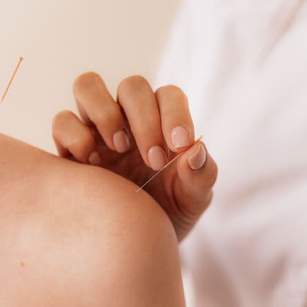  Akupunkturnadeltherapie auf der Schulter eines Patienten