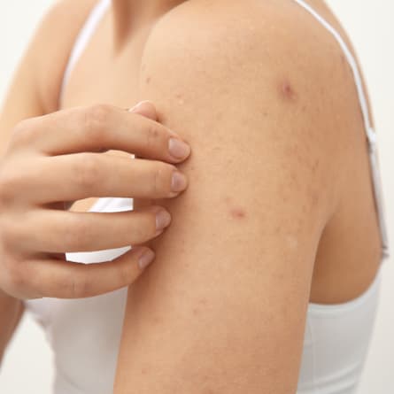 Eine Frau kratzt sich am Arm.